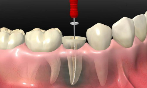 Root Canal Treatment
