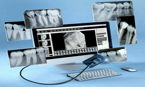 RadioVisioGraphy (RVG) X-Ray